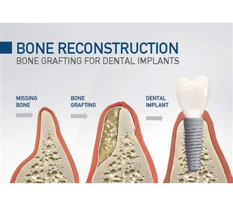 Guided Bone Regeneration in Las Vegas, NV .